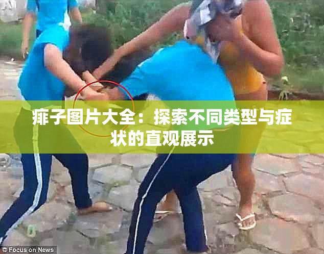 痱子图片大全：探索不同类型与症状的直观展示